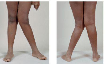 k-leg