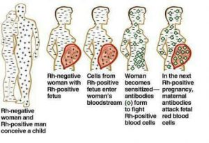 Your spontaneous miscarriages might be as a result of Rhesus factor