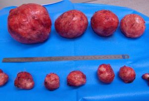 7 Signs That You May Have Fibroid