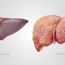 Liver Cirrhosis in Nigeria; Causes, Treatment & Natural Remedies