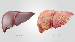 Liver Cirrhosis in Nigeria; Causes, Treatment & Natural Remedies