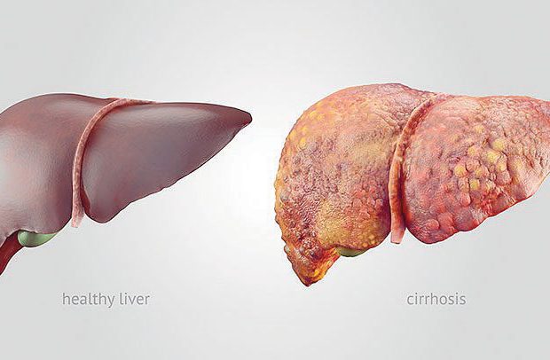 Liver Cirrhosis in Nigeria; Causes, Treatment & Natural Remedies