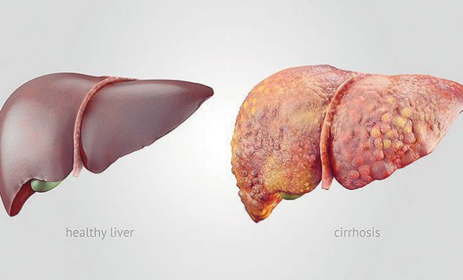 Liver Cirrhosis in Nigeria; Causes, Treatment & Natural Remedies