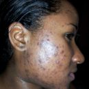 Beauty tips to prevent Acne