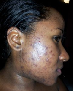 Beauty tips to prevent Acne