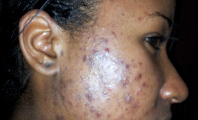 Beauty tips to prevent Acne